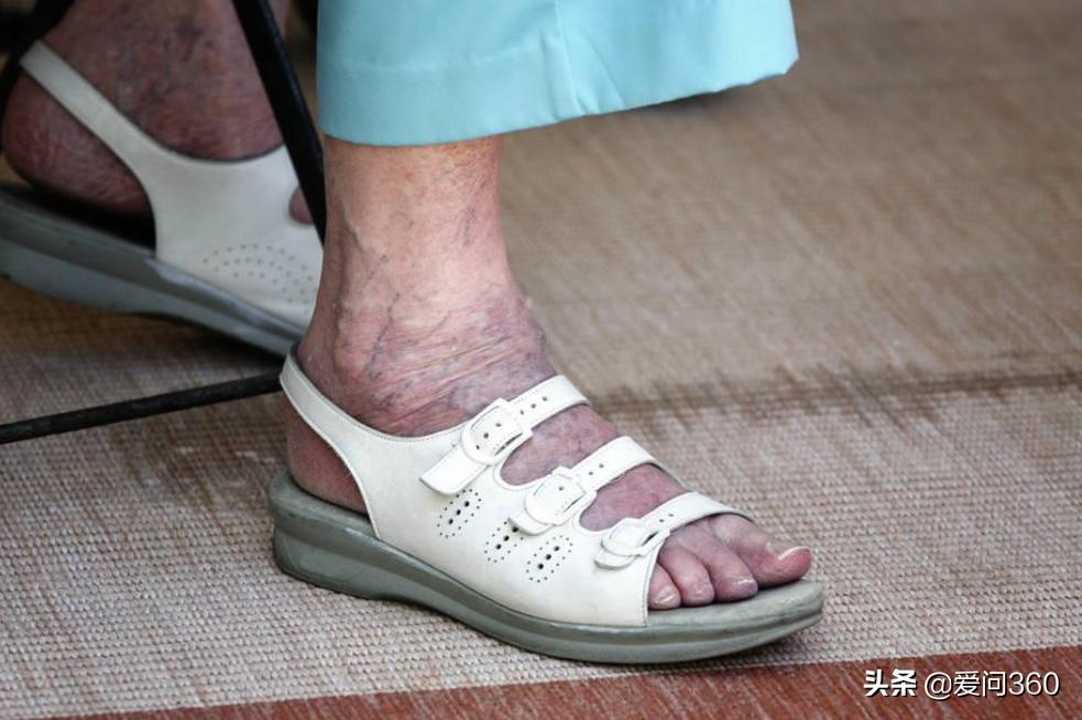 中老年人脚后跟开裂，大多是这些原因造成的，5个方法可改善