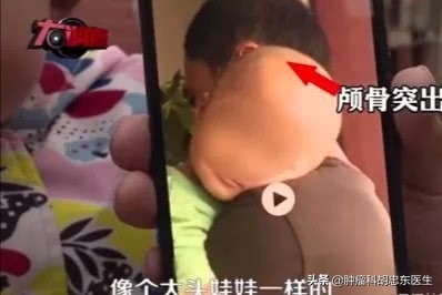 喝奶粉的孩子容易得佝偻病吗,如果发现幼儿有佝偻病怎么办