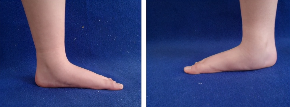 小孩跑步老是摔倒要不要做ct,8岁小孩跑步爱摔跤怎么回事