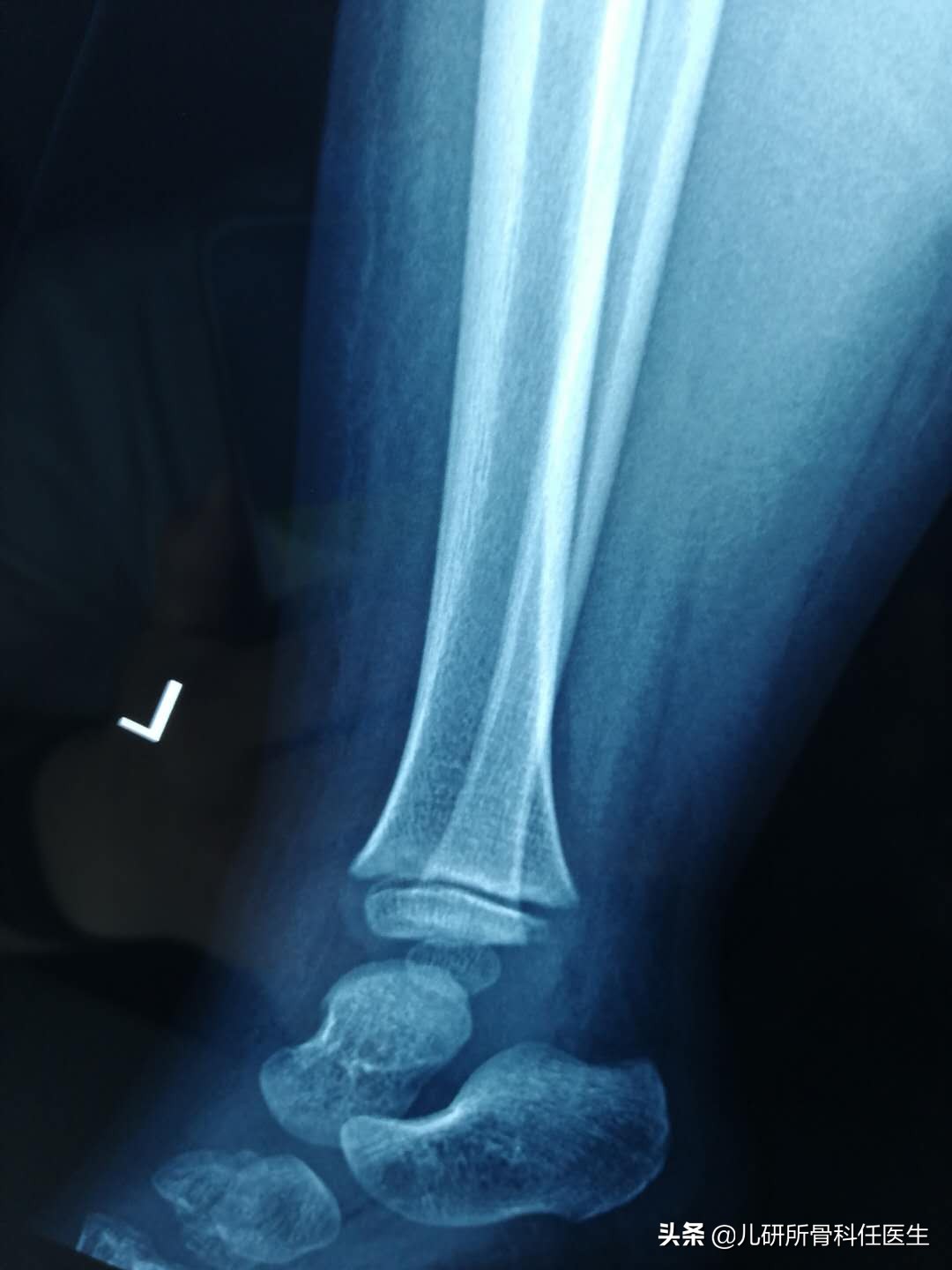 宝宝被蚊虫叮咬的正确处理方法,宝宝被蚊虫叮咬后如何正确处理