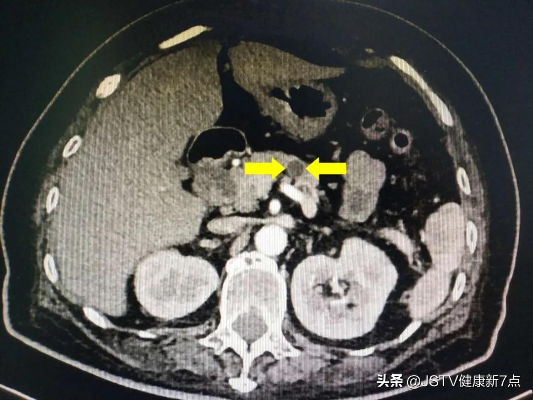 糖尿病人血糖多高怀疑是胰腺癌,胰腺癌患者有糖尿病血糖会更高吗