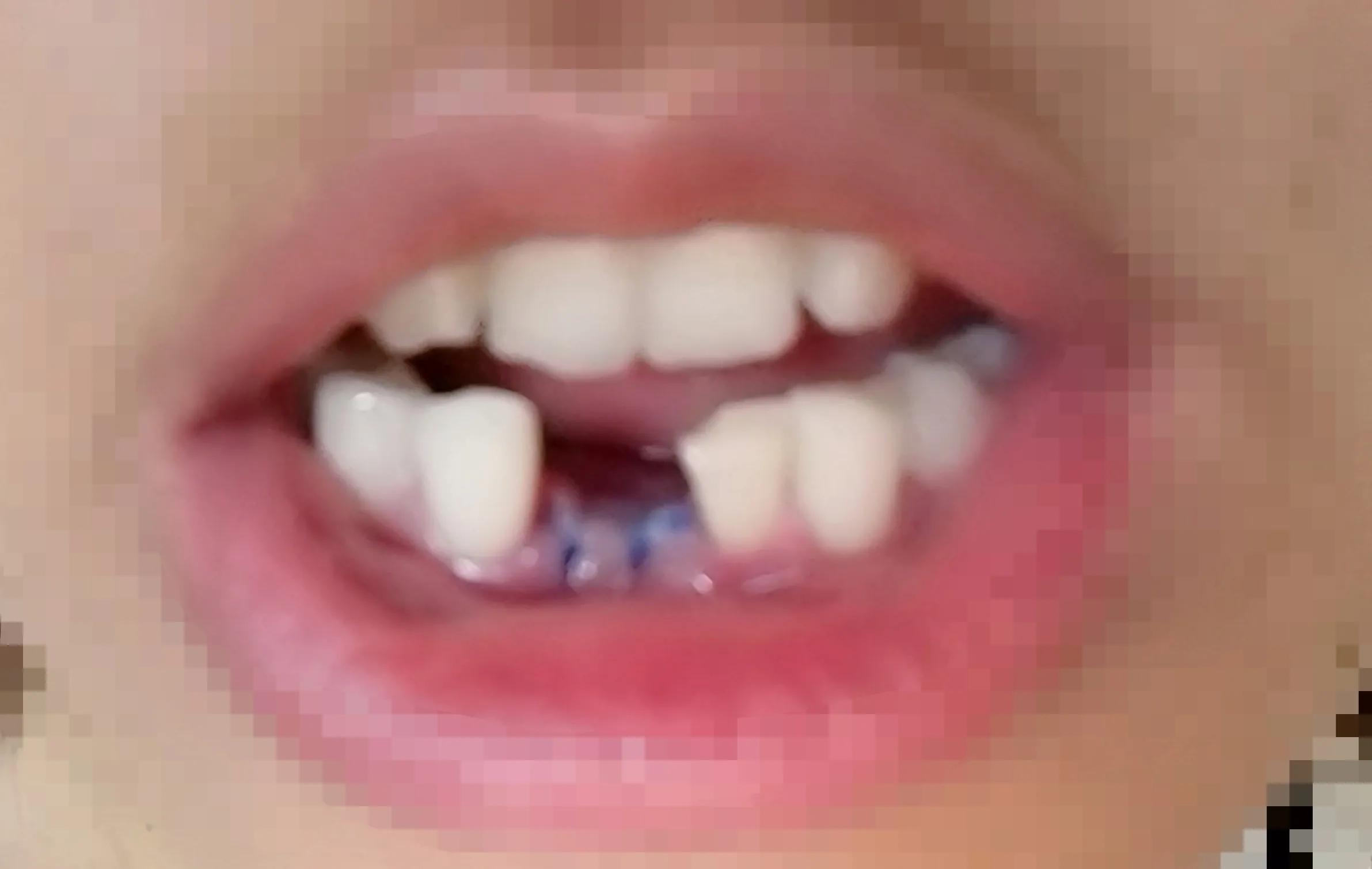 有没有种牙的经历,种牙经历及感受