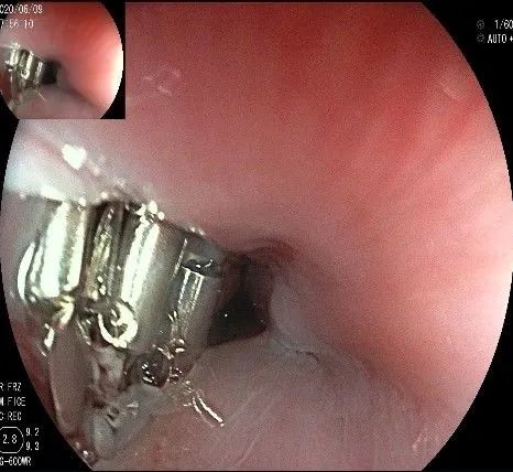 贲门隆起性病变影像,贲门溃疡隆起性病变