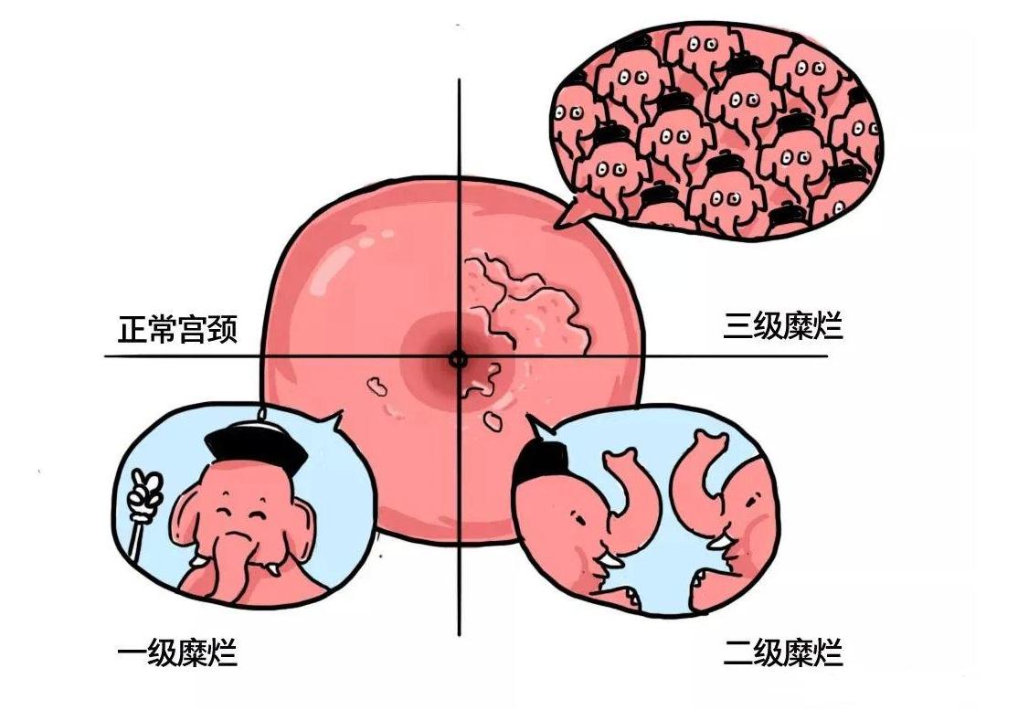 宫颈糜烂真的需要治疗吗,宫颈糜烂并不可怕怎么治疗呢