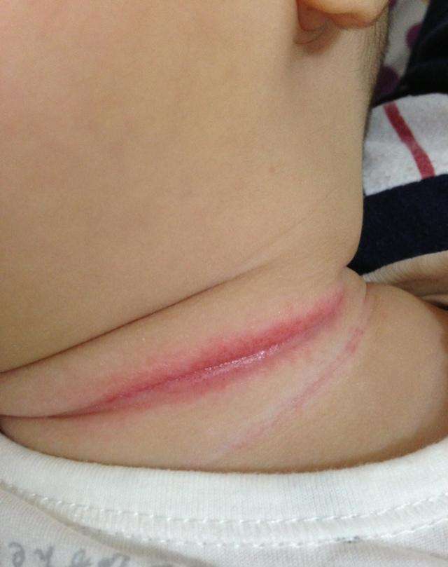 宝宝容易淹脖子怎么办,宝宝淹脖子什么原因