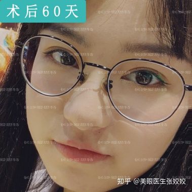 内双的人割双眼皮会更自然吗,怎么把内双变双眼皮的自然方法