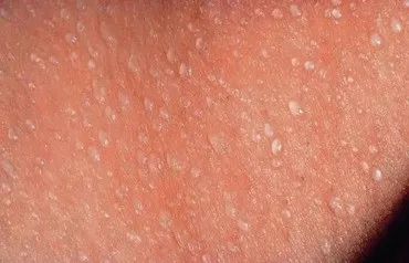 新生儿痱子怎么治好得快,新生儿痱子的最佳治疗方法