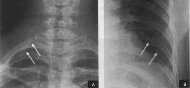 x线影像解剖大全,胸部x线怎么看懂图解