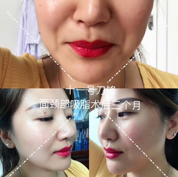 面部吸脂后的恢复过程,下颌缘吸脂肿成猪头