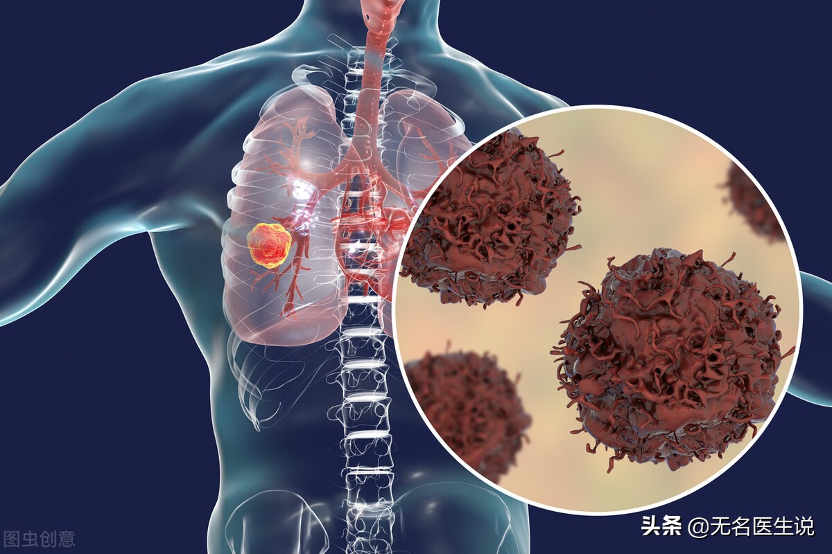 癌症的癌细胞,肺部原位癌是癌症吗