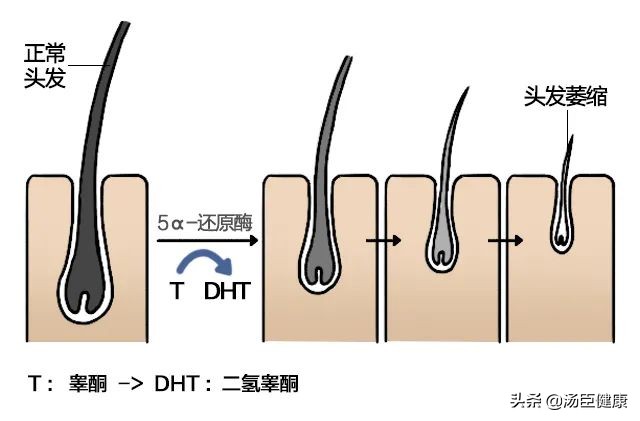 其它地方的毛发可以移植到头上吗,身上的毛可以移植到头发上吗