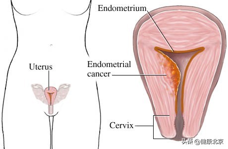 年轻女性容易得的重大疾病,子宫内膜癌饮食注意什么