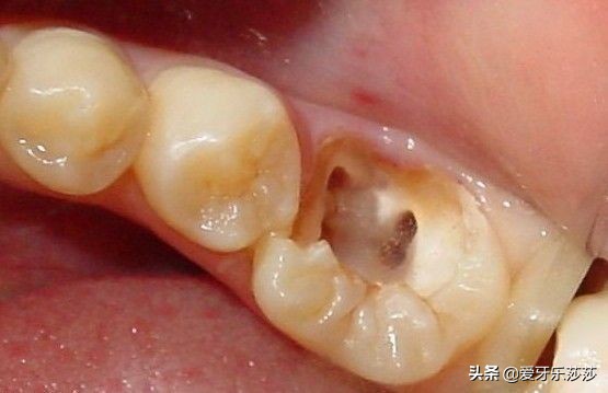 根管治疗2年后牙疼怎么办,牙疼根管治疗最后一次了