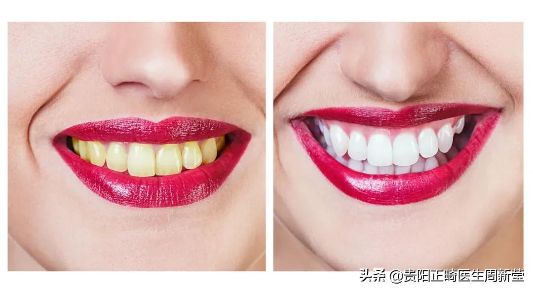 天天刷牙牙齿黑斑点,天天刷牙还是黄牙正确方法请收好