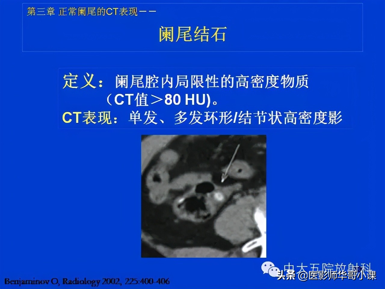阑尾炎课件,阑尾炎的超声课件