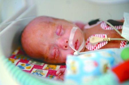 生了唐氏婴儿怎么处理,生个早产儿