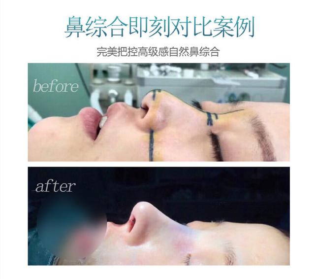 那些隆胸成功的人,那些隆鼻过的女人现在都怎么样了