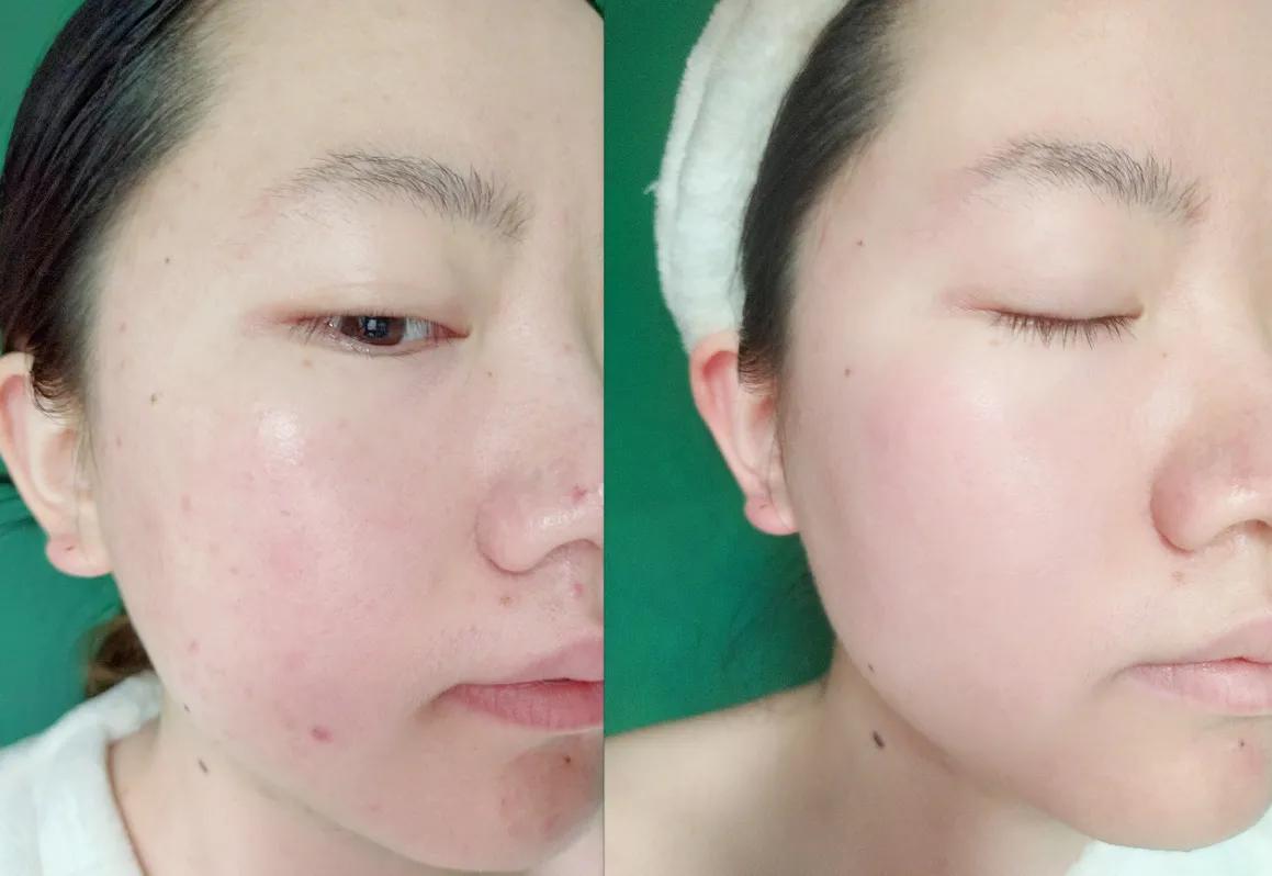 夏季干皮补水哪个牌子好,40岁混干皮夏季适合什么护肤品