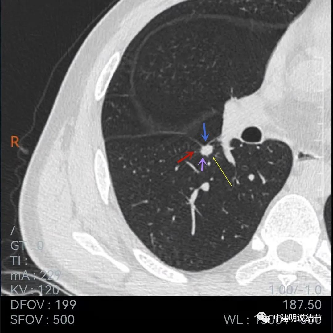 问诊分析:存在了4年的实性结节会不会是肺癌?