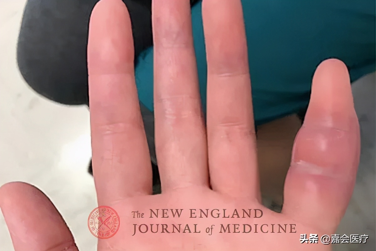 妻子左手小指头肿胀,竟是丈夫外出旅行导致的?