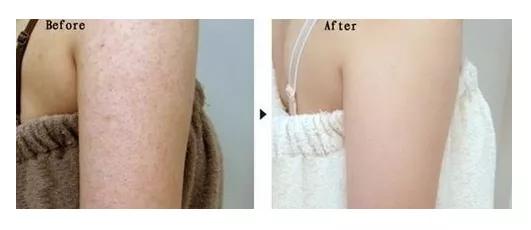 羊奶皂能去鸡皮肤吗,驴奶皂与羊奶皂哪个好