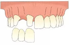 烤瓷牙镶上再弄掉会不会有影响,已经做了烤瓷牙还有必要种植吗
