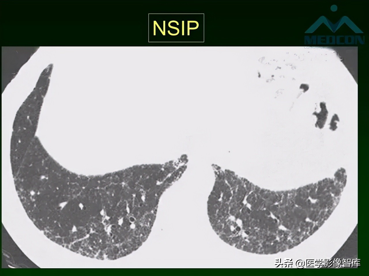 肺弥漫性网状影,两肺小叶间隔增厚可见网状模糊影