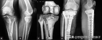 胫腓骨骨折愈合慢吃什么药,胫腓骨骨折愈合慢吃什么药长得快