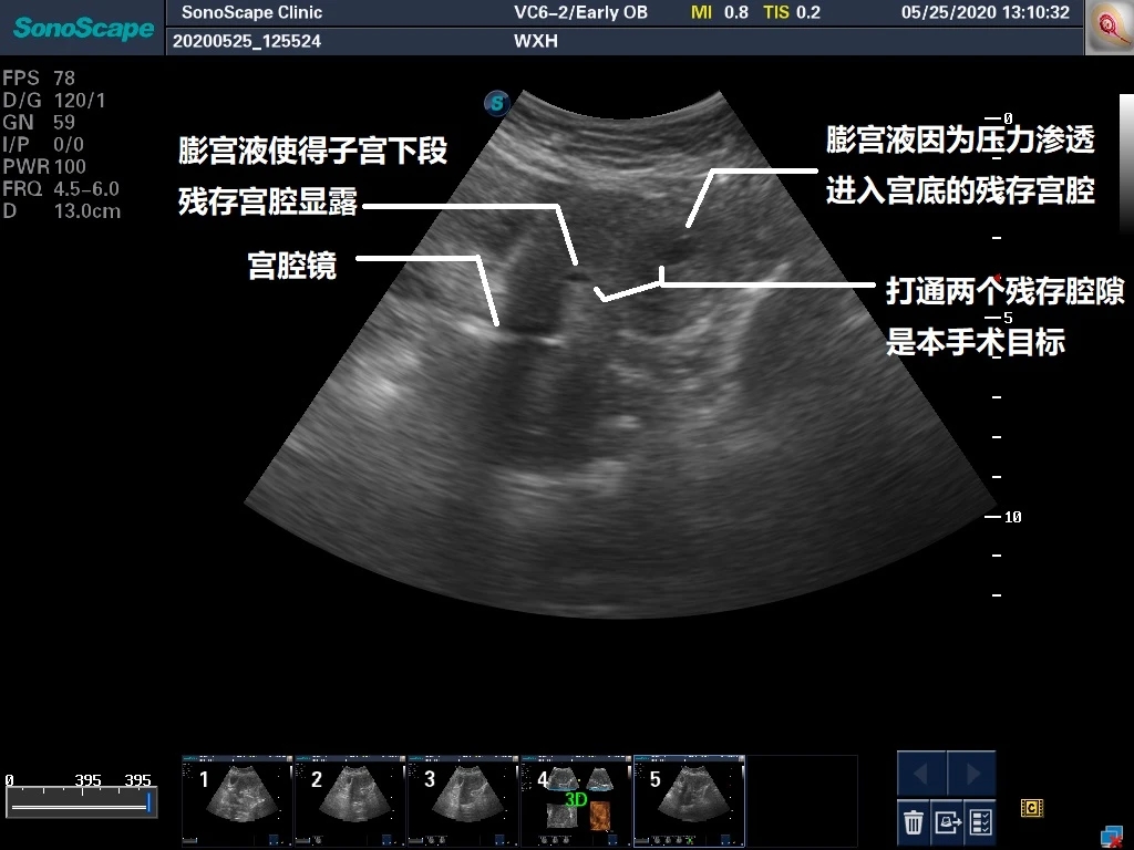 轻微宫腔粘连手术成功案例,轻度宫腔粘连分离术是大手术吗
