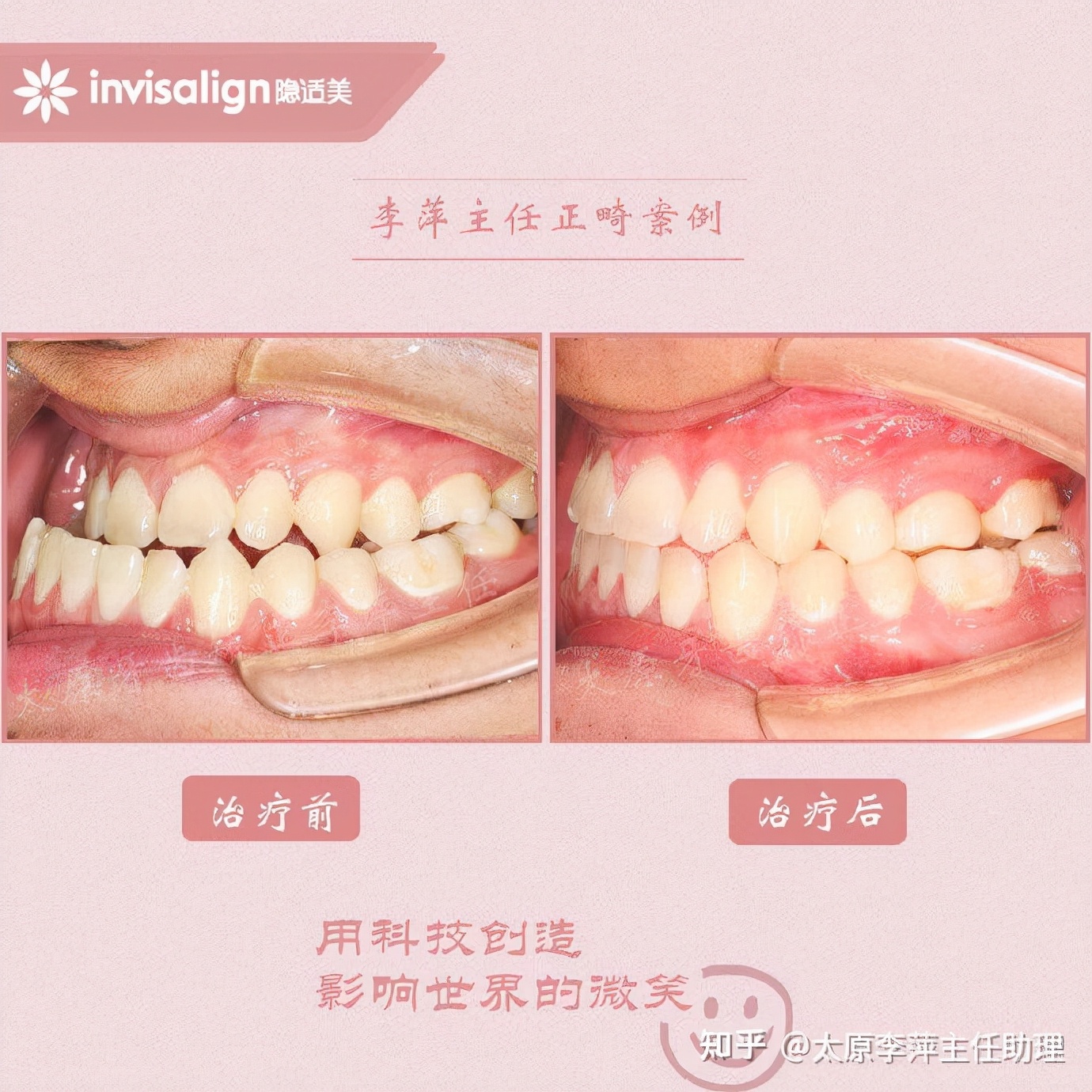 太原牙齿矫正靠谱吗,太原成人隐形牙套牙齿不齐