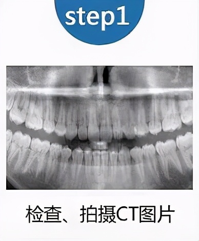 老人家种牙去哪里最好,50岁种牙最好方法怎么种