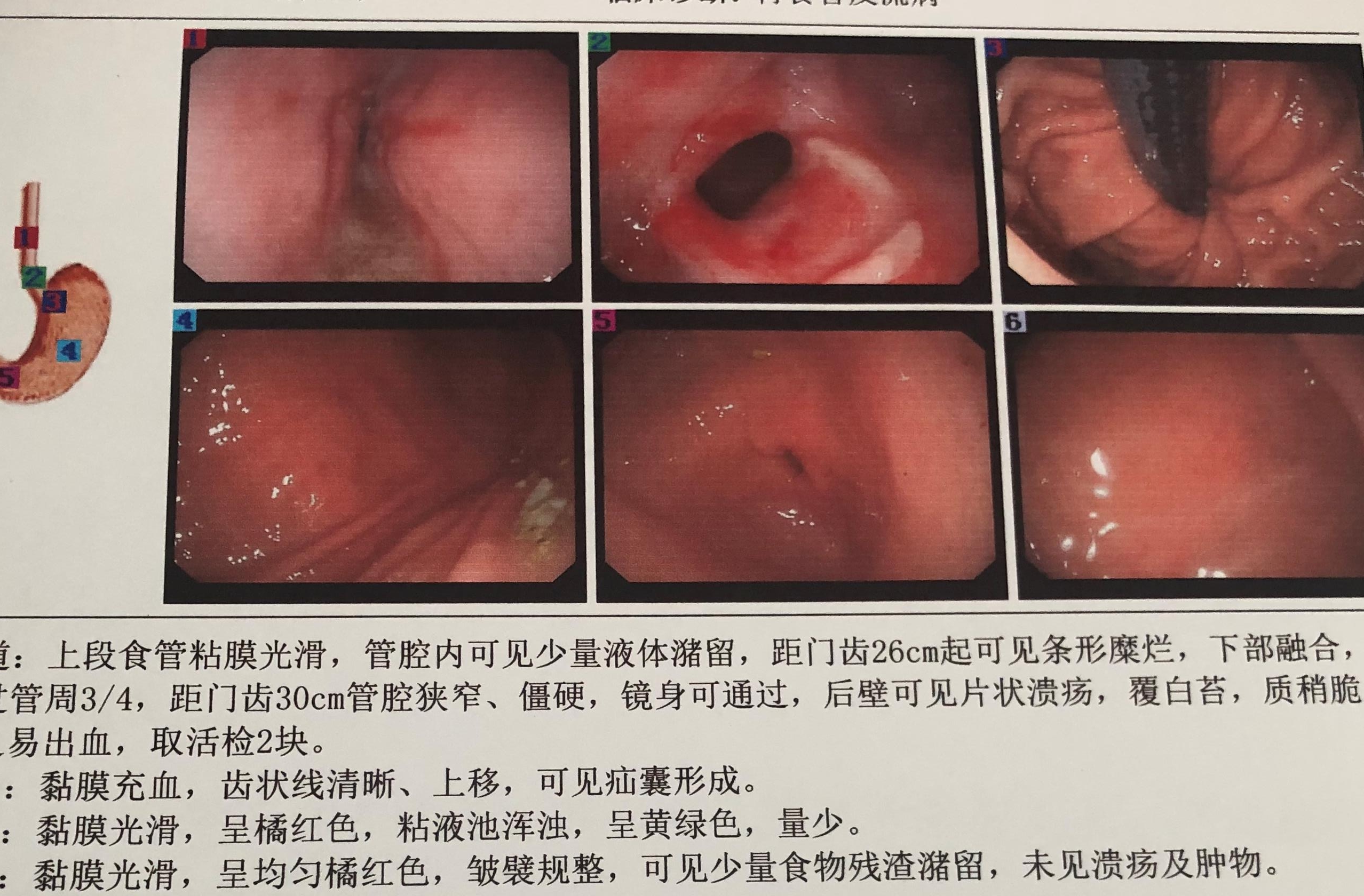 咽炎咽喉异物鼻窦炎一招解决,鼻窦炎后咽炎怎么治疗彻底除根