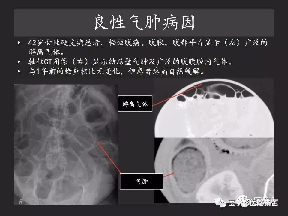 空腔脏器穿孔和胃肠道穿孔区别,腹膜后穿孔一般是哪里穿孔