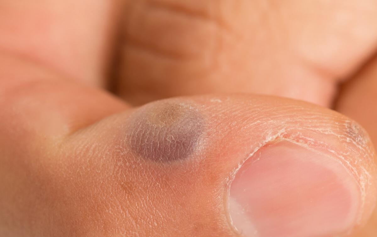 目前填充法令纹最好的办法,永久填充法令纹的方法