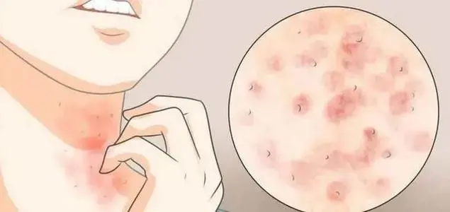 神经性皮炎中药治疗方法,神经性皮炎止痒最佳方法