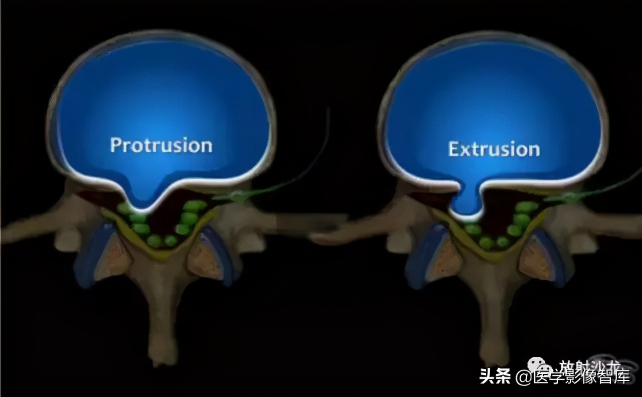 一键收藏所有的内容,颈椎间盘病变的症状和治疗