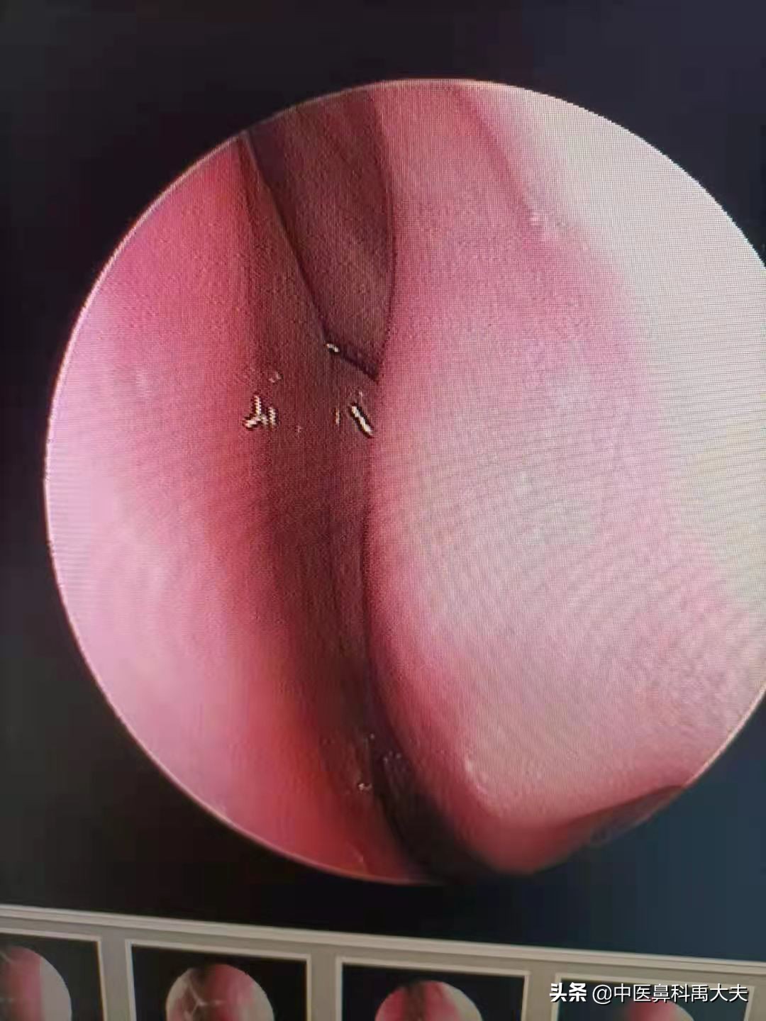 鼻炎怎么治教你一招改善鼻炎问题,过敏性鼻炎用哪一种洗鼻炎好