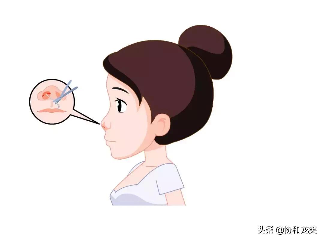 什么是假体隆鼻术,什么是微创隆鼻术