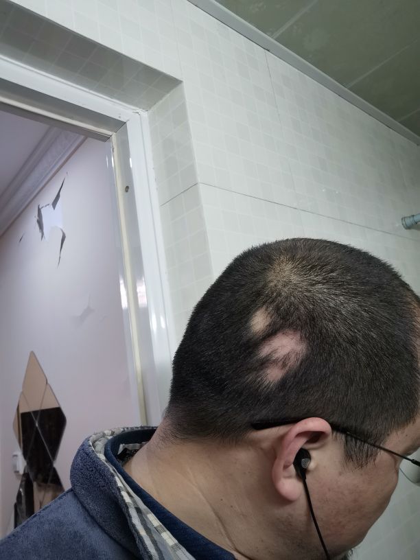 发现斑秃刚好又开始掉头发怎么办,突然发现斑秃怎么治疗