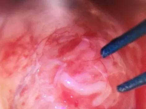 一文读懂颈动脉彩超,一文读懂肿瘤基因检测