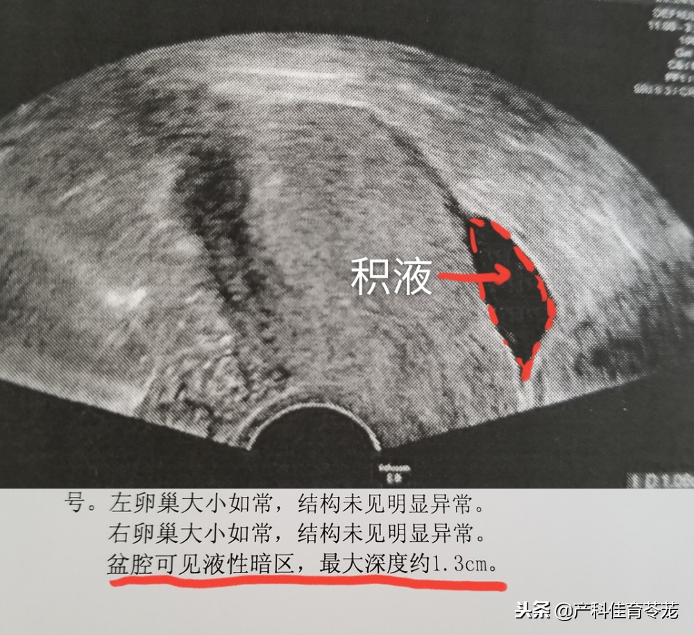 妇科b超报告单解析,妇科b超报告单几个月有效