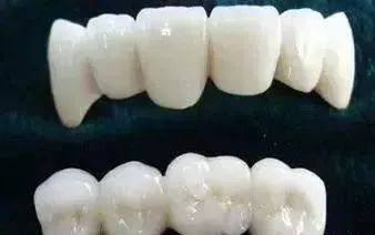 全瓷牙冠在保质期可以免费重做吗,全瓷牙冠价格表2021款报价