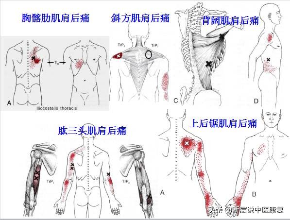 激痛点挂图,激痛点疗法笔记