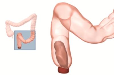 儿童便秘拉不出粑粑怎么办,孩子便秘拉不动