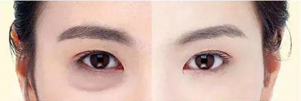 卧蚕和眼袋的区别在哪里,卧蚕和眼袋的区别照片