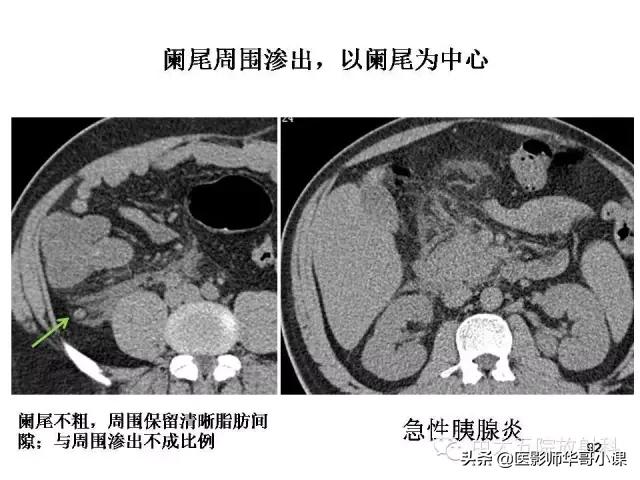 阑尾炎课件,阑尾炎的超声课件