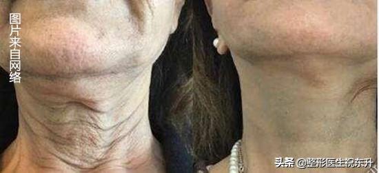 颈纹可以用颈纹霜去除吗,你的颈纹在哪里