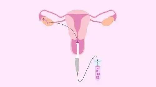 试管婴儿取卵，无痛取卵与有痛取卵谁好？