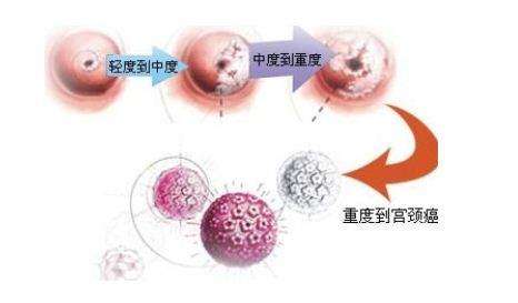 什么是宫颈癌的二级预防,宫颈癌常见的护理问题