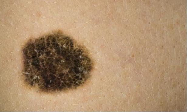 癌症信号早知道,癌症早期信号